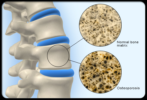 بیماری پوکی استخوان در کمین استخوانهای بدن انسان