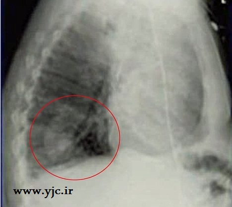 عجیب ترین چیزهایی که در بدن پیدا شده است +عکس