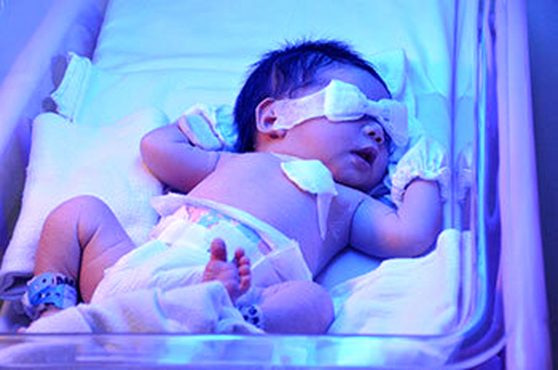 پژوهشگران رفسنجانی روش راحتی برای کاهش زردی نوزادان ارائه کردند