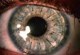 دو پیوند قرنیه چشم در رفسنجان انجام شد